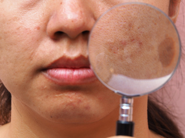 What Is Pigmentation/Melasma?